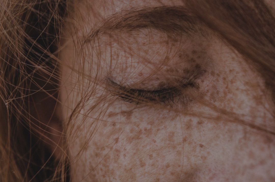 Rostro femenino en primer plano con pecas, ojo derecho cerrado y cabello despeinado que cubre parte del ojo.